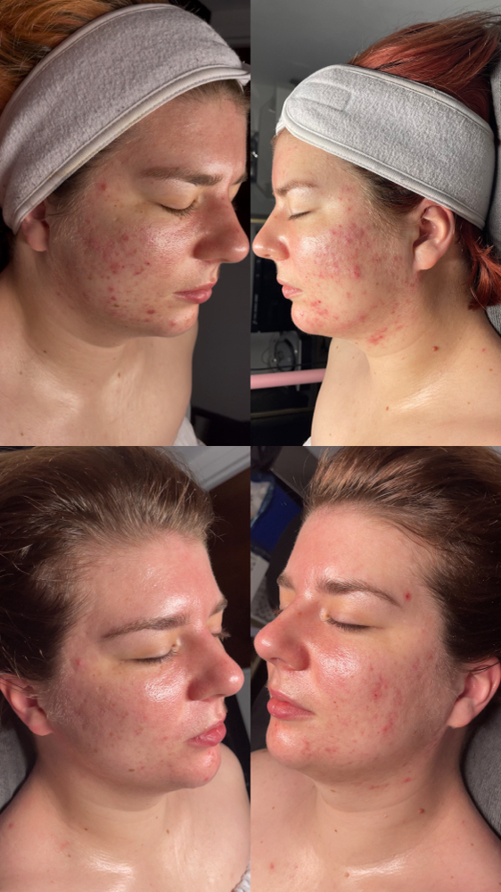 Acne Bootcamp - Mission 1: Clear Complexion