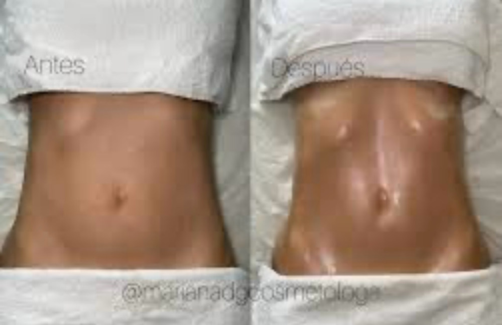 Sculp With Lymphatic Therapy at Merry Spa in Huntington, NY