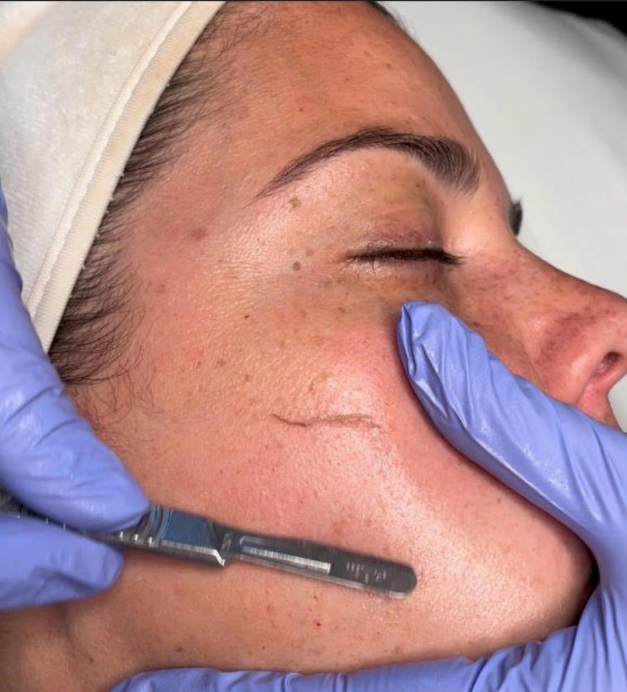 Dermaplane Facial at Dreamy Skin in Westerville, OH