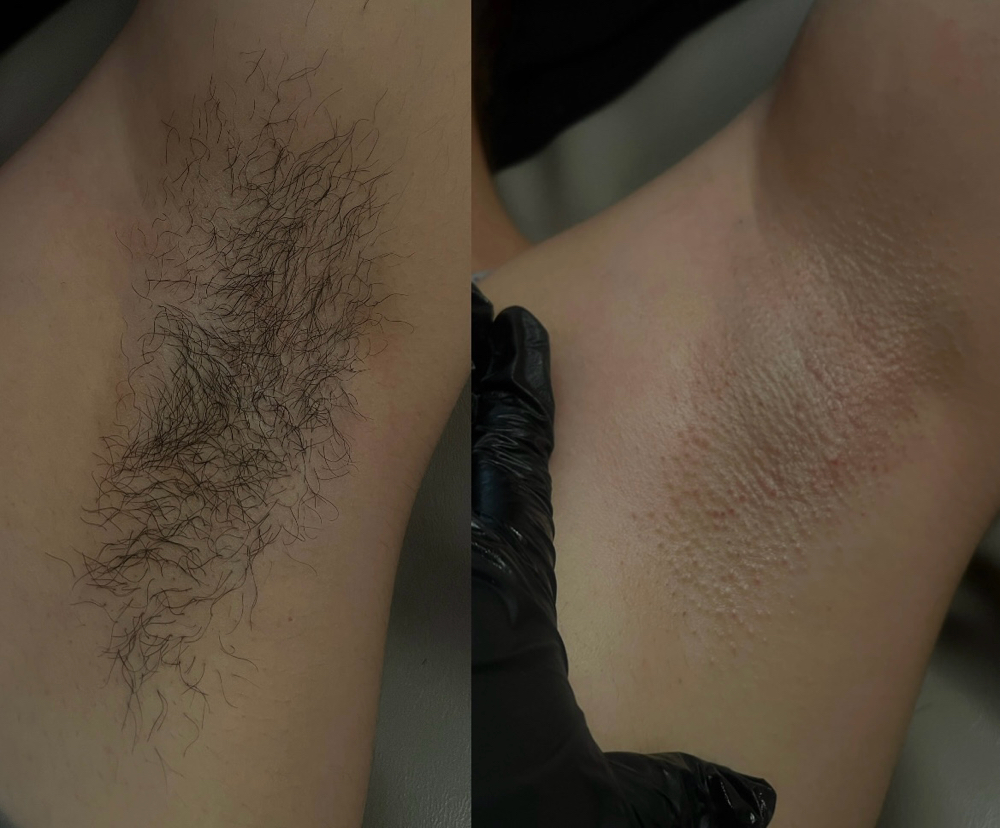 Underarm