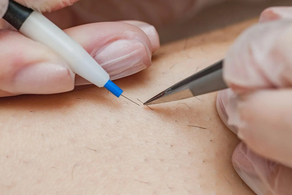 Permanent Hair Removal