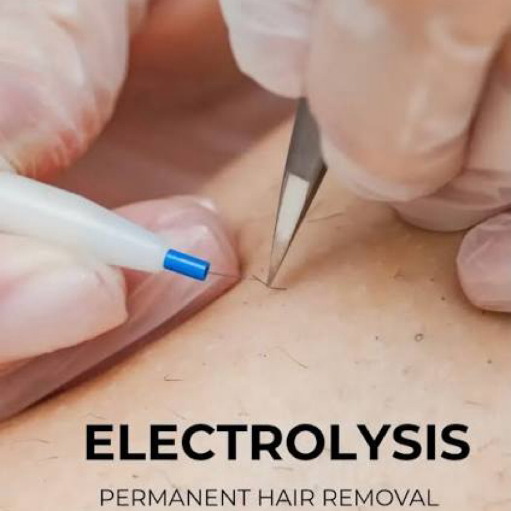 Permanent Hair Removal at Nara’s Electrolysis in Watertown, MA