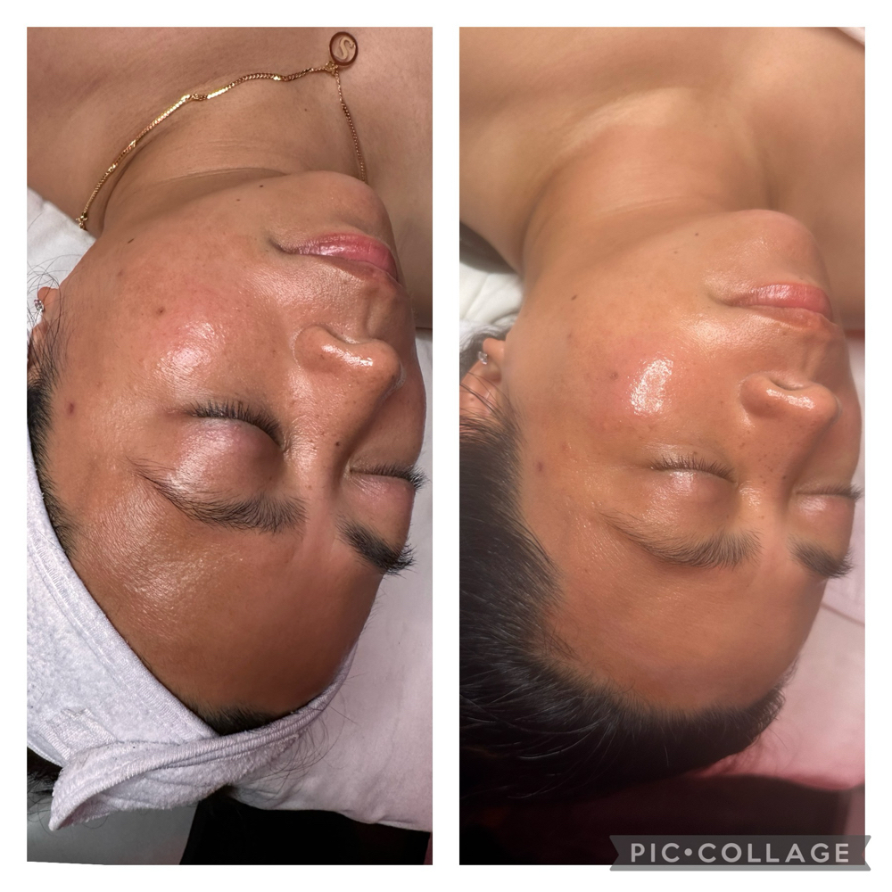 Hydradermabrasion Facial