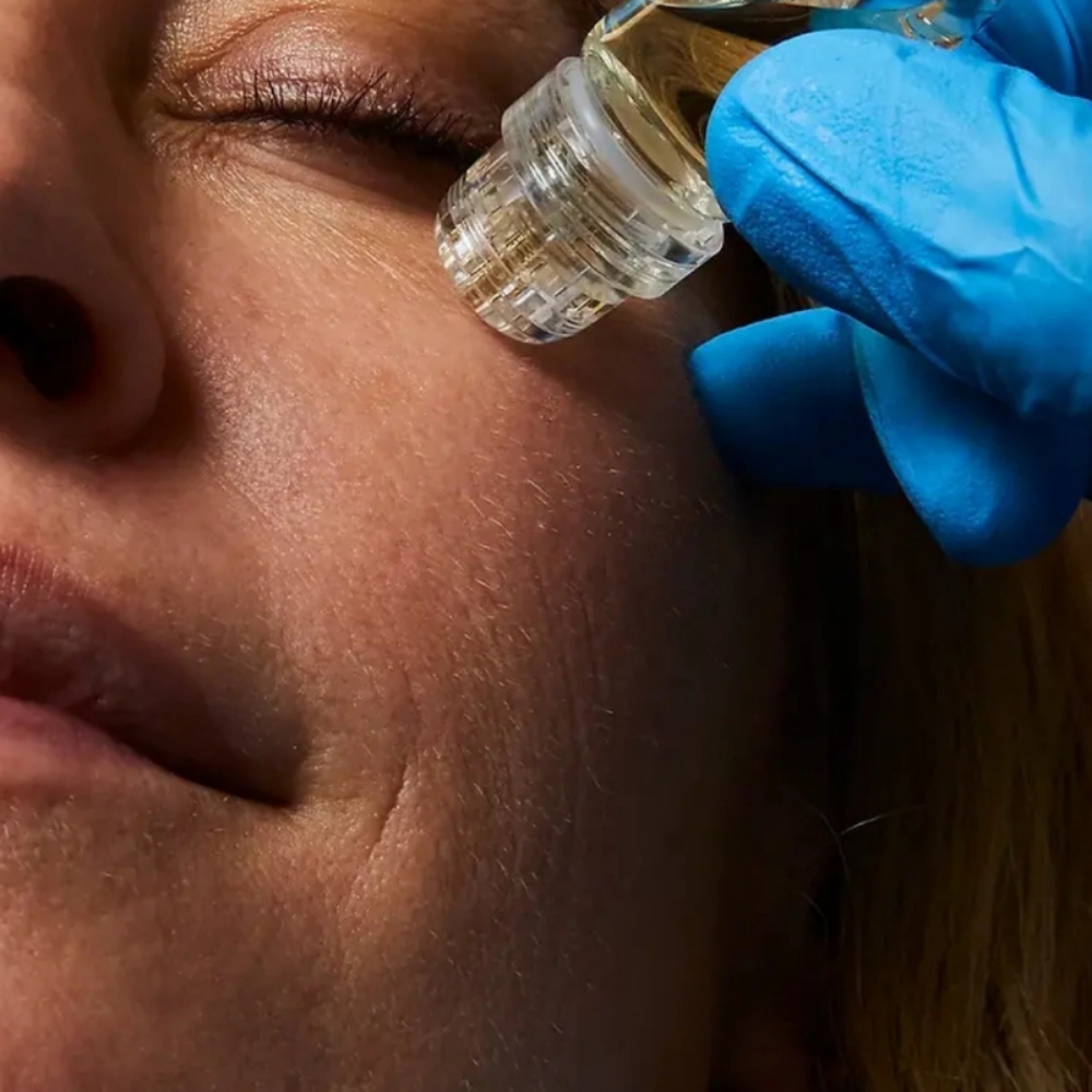 Micro-Tox at Angel Face Skin Care in Madera, CA