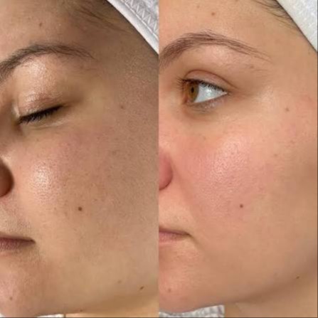 Dermaplane Express Facial at Sage Skin & Aesthetics in Kennewick, WA