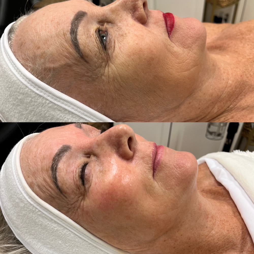 Anti- Aging Carboxy + VLIFT Facial