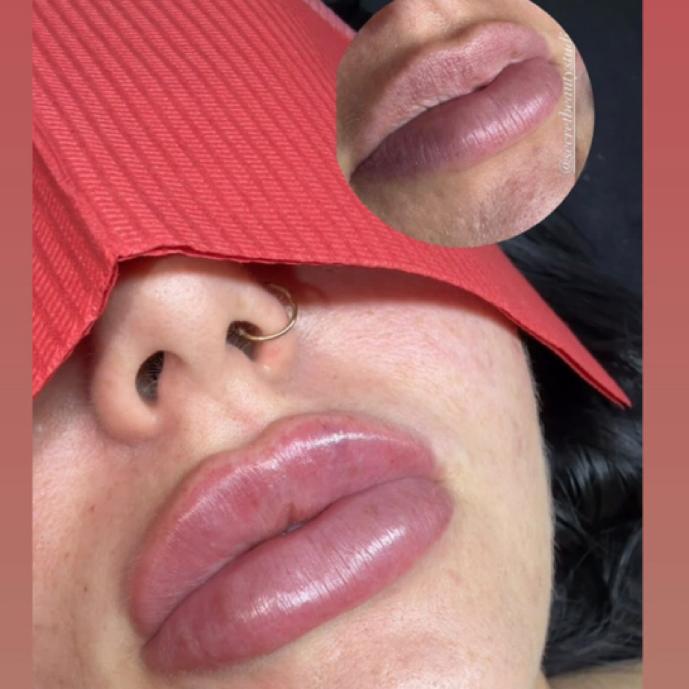 Lip Filler - 2ML(TWO SESSIONS) at Secret Beauty Studio in Ok, OK