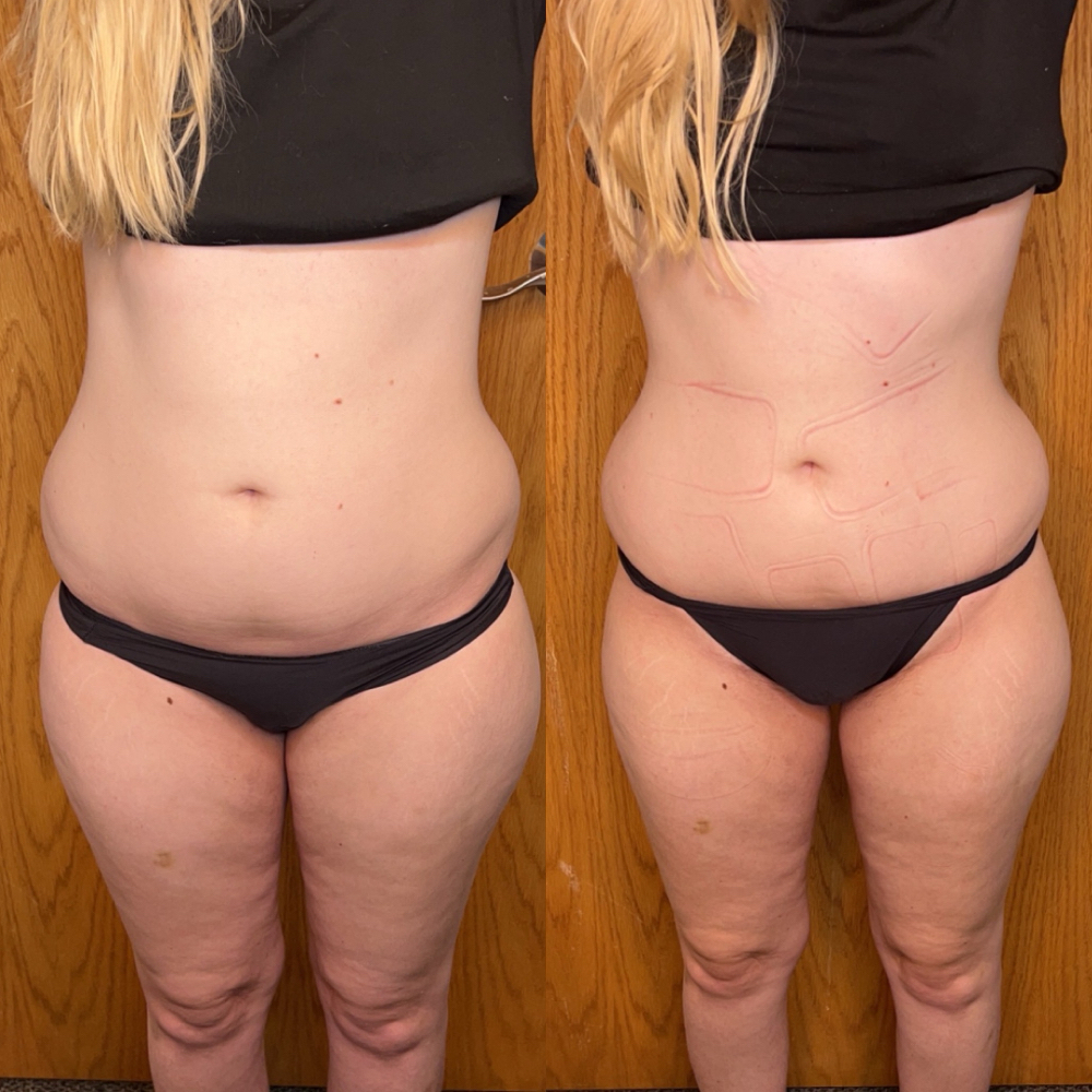 Buy 1 GET 1 FREE Hot Mom Bod Deal at Kayboo Beauty in Colorado Springs, CO