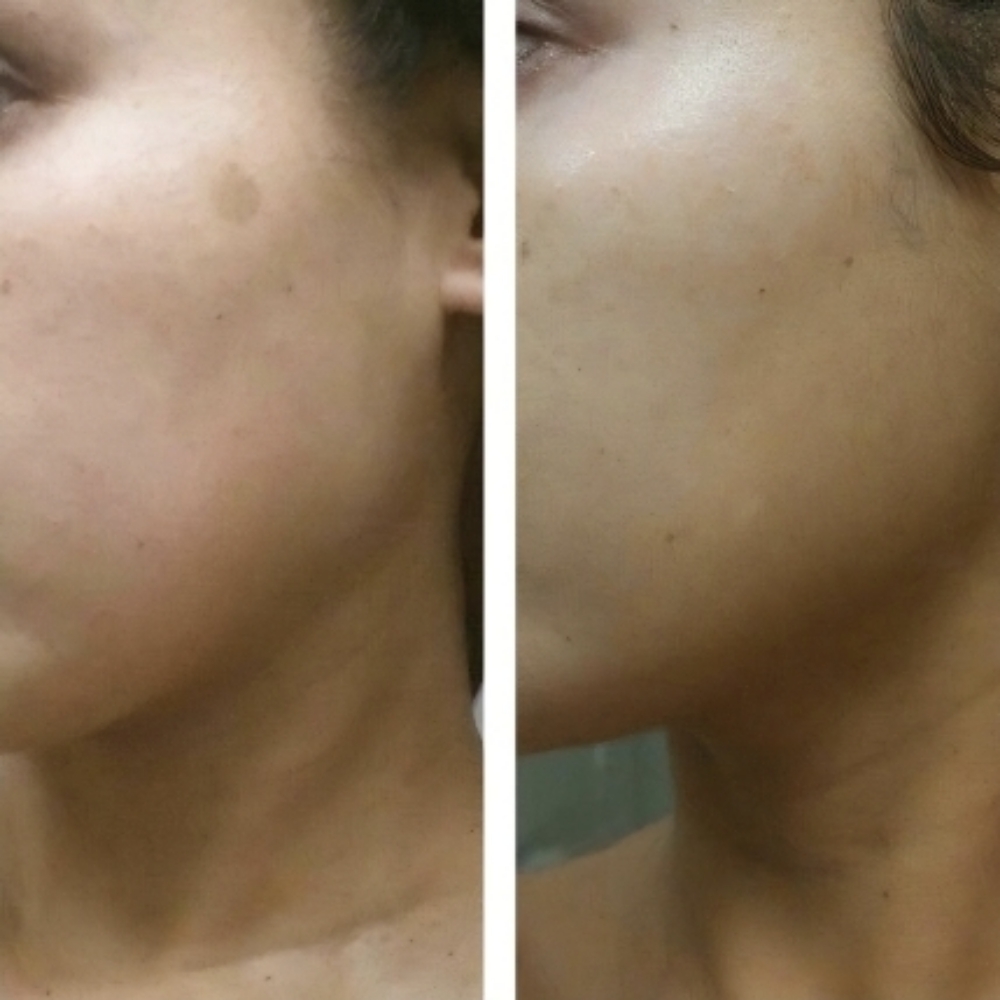 Chemical Peel Dark Spot Treatment at LexGlo Esthetics in Idaho Falls, ID