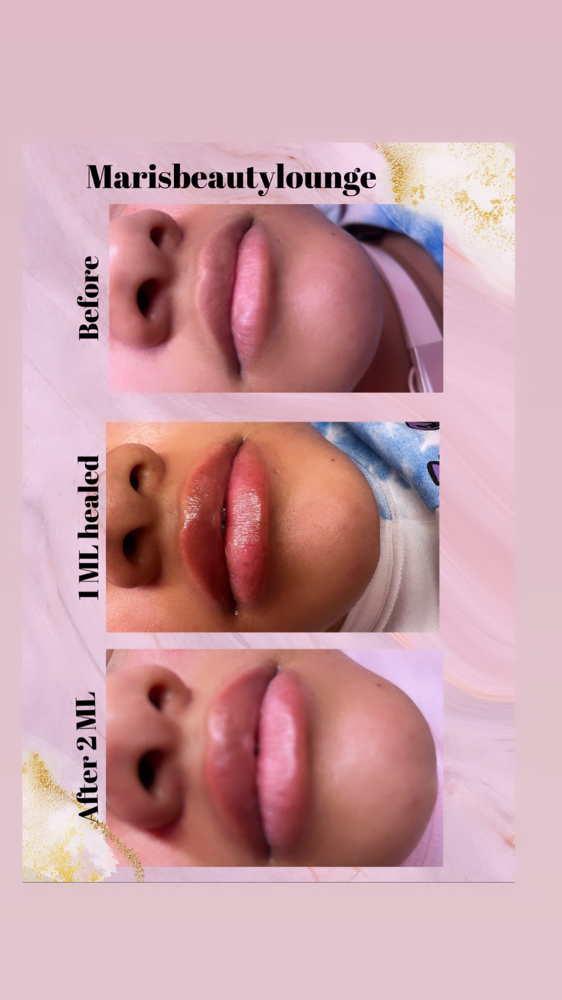 Lip Filler Needleless pen 1ml