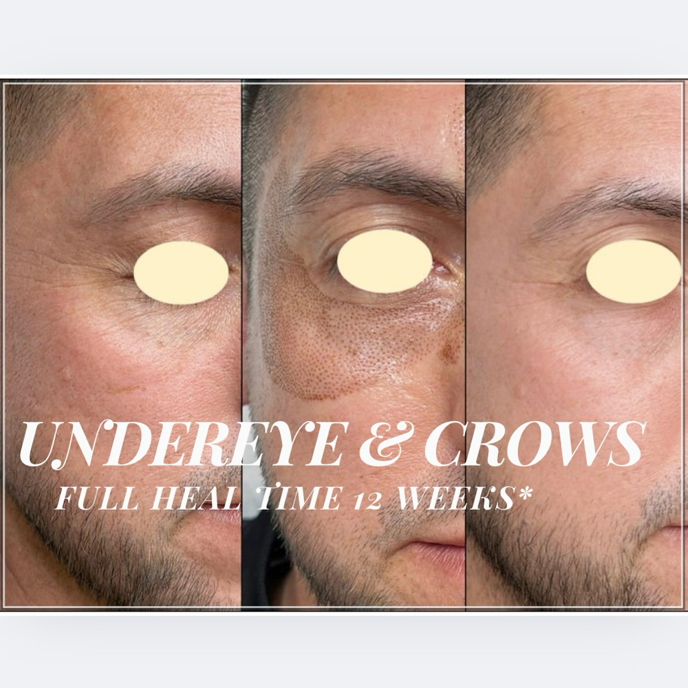 Crows Feet & Undereye
