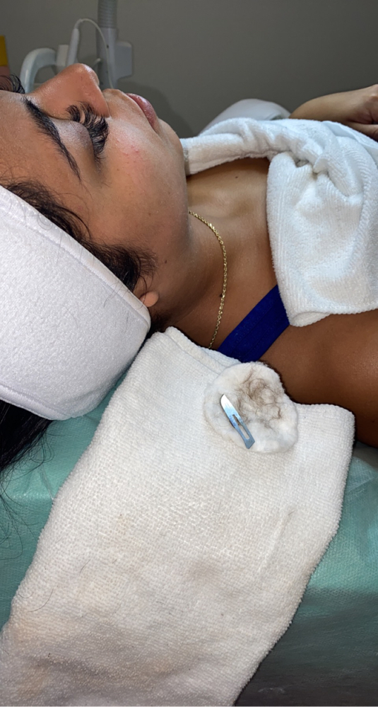 Dermaplanning