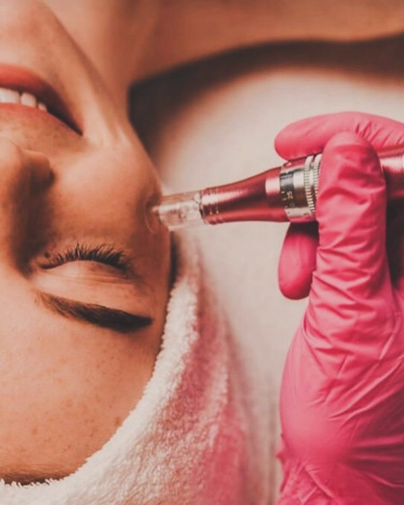 MICRONEEDLING FACIAL