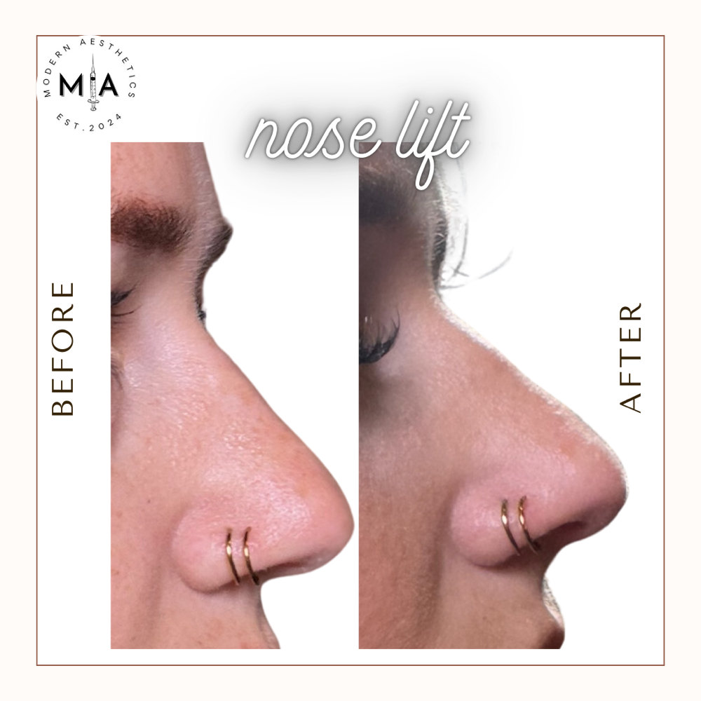 Nose Lift