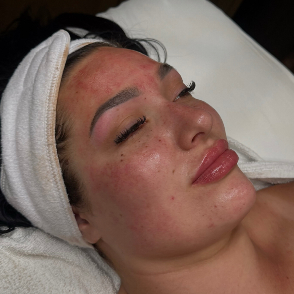 Microneedling Collagen Renewal at SKIN BY HAYLEE in Rochester, MN