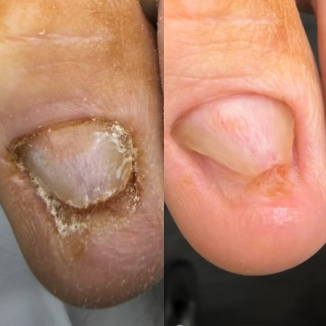 Toe Nail Debridement ADVANCED at Naba Style Nails in McKinney, TX