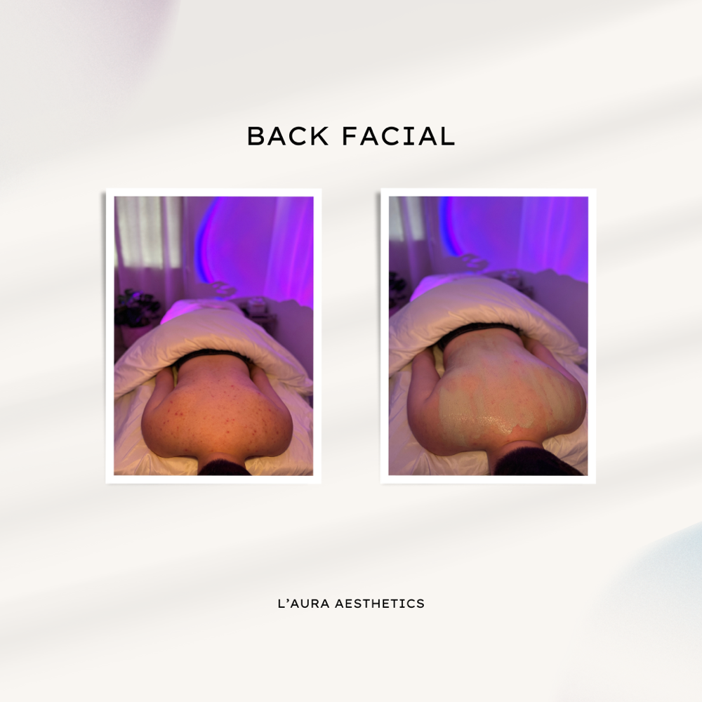 Back Facial