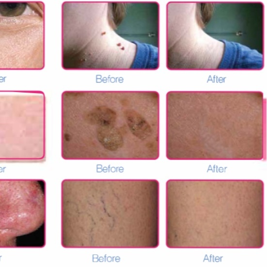 Sun Spot Removal at The Indy Facialist in Greenwood, IN