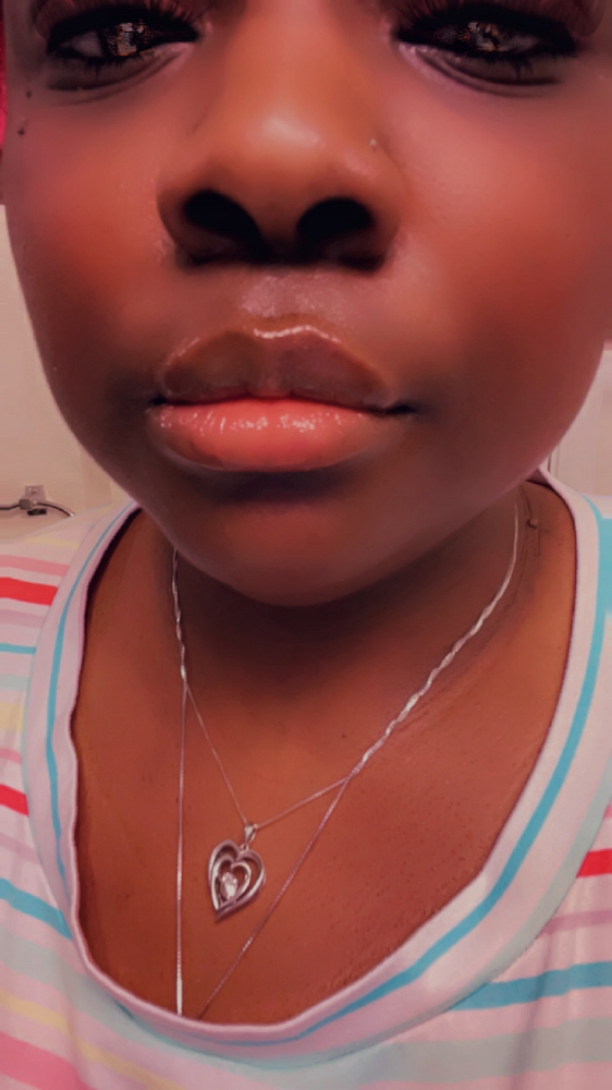 Lip Filler 1ml