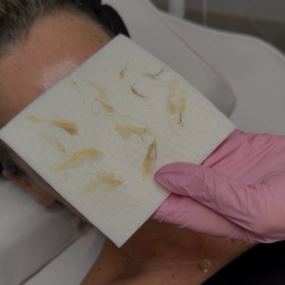Dermaplaning Facial at The Refinery Room in Alvin, TX