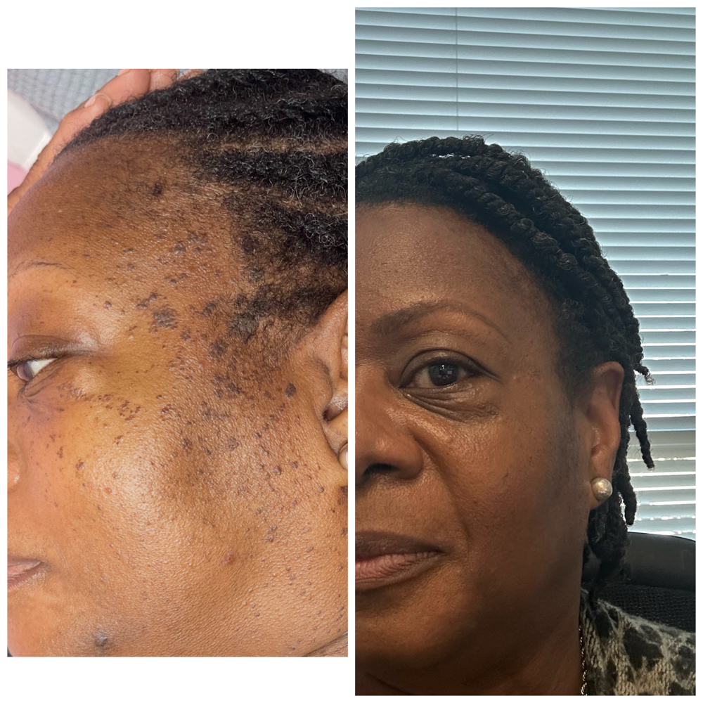 Full Face/Neck Tags Removal at Clinical Complexions in Merrillville, IN