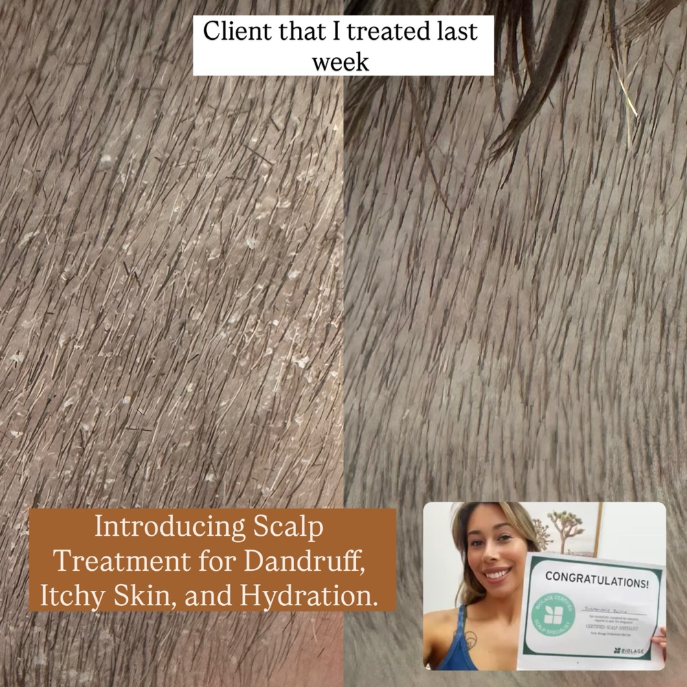 Scalp Treatment