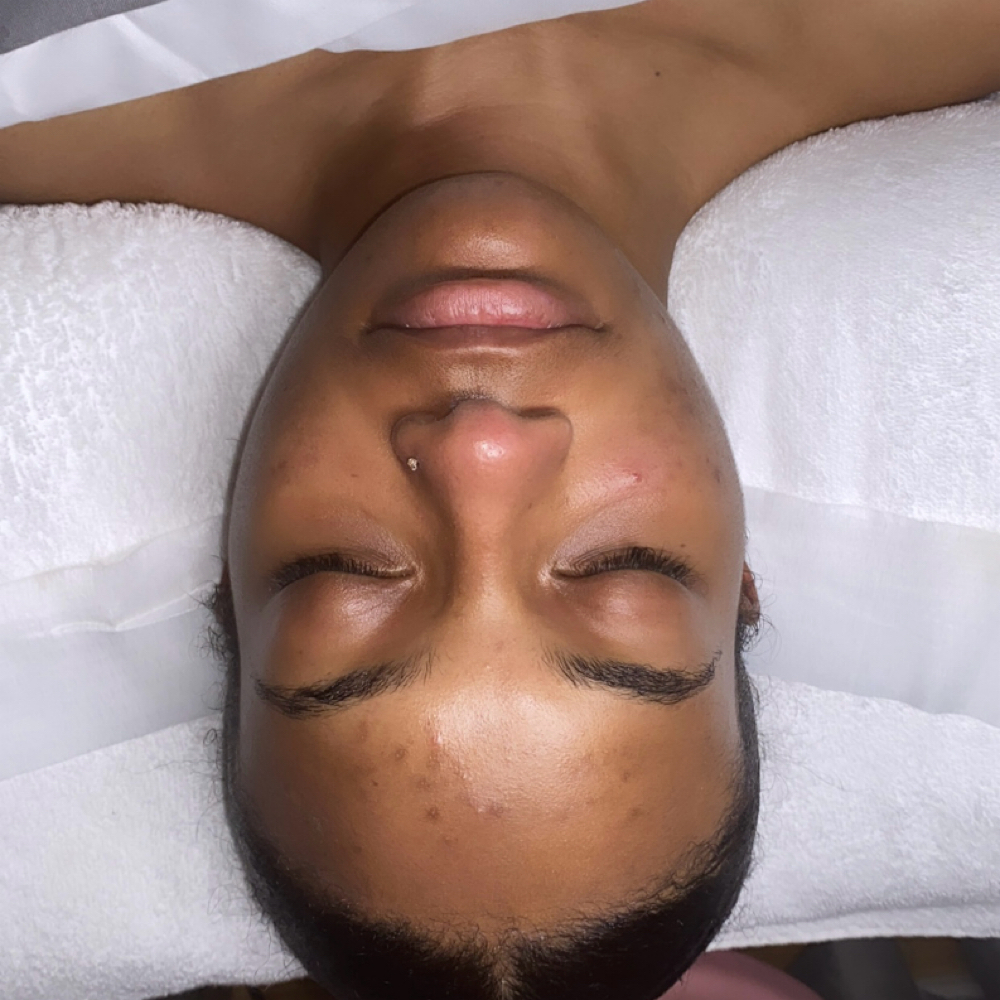 Teen Breakout Facial at The Skin Gallery in Los Angeles, CA