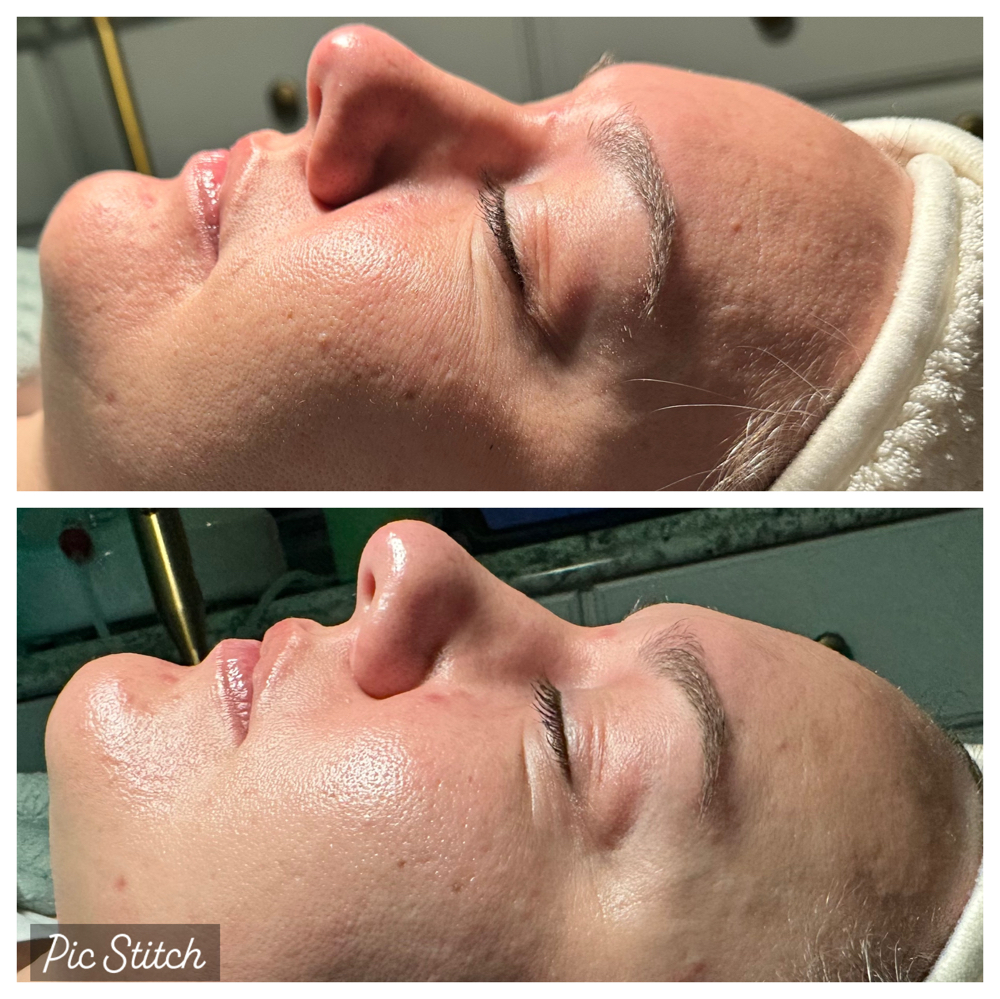 Add On Microdermabrasion