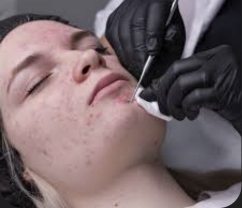 Acne Facial