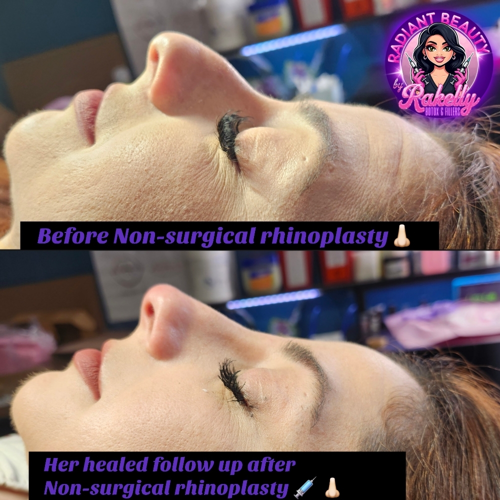 Non-surgical Rhinoplasty at Radiant Beauty By Rakelly LLC in Fort Worth, TX