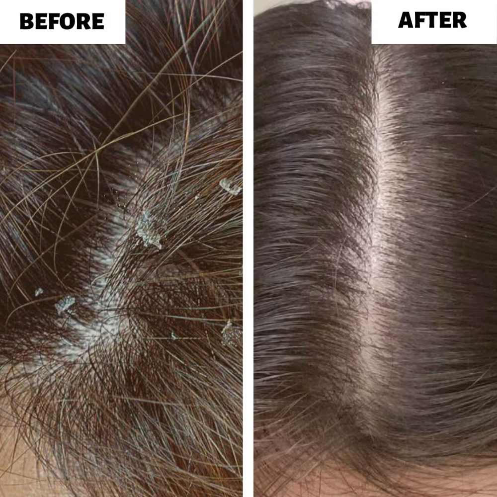 The Scalp Treatment -