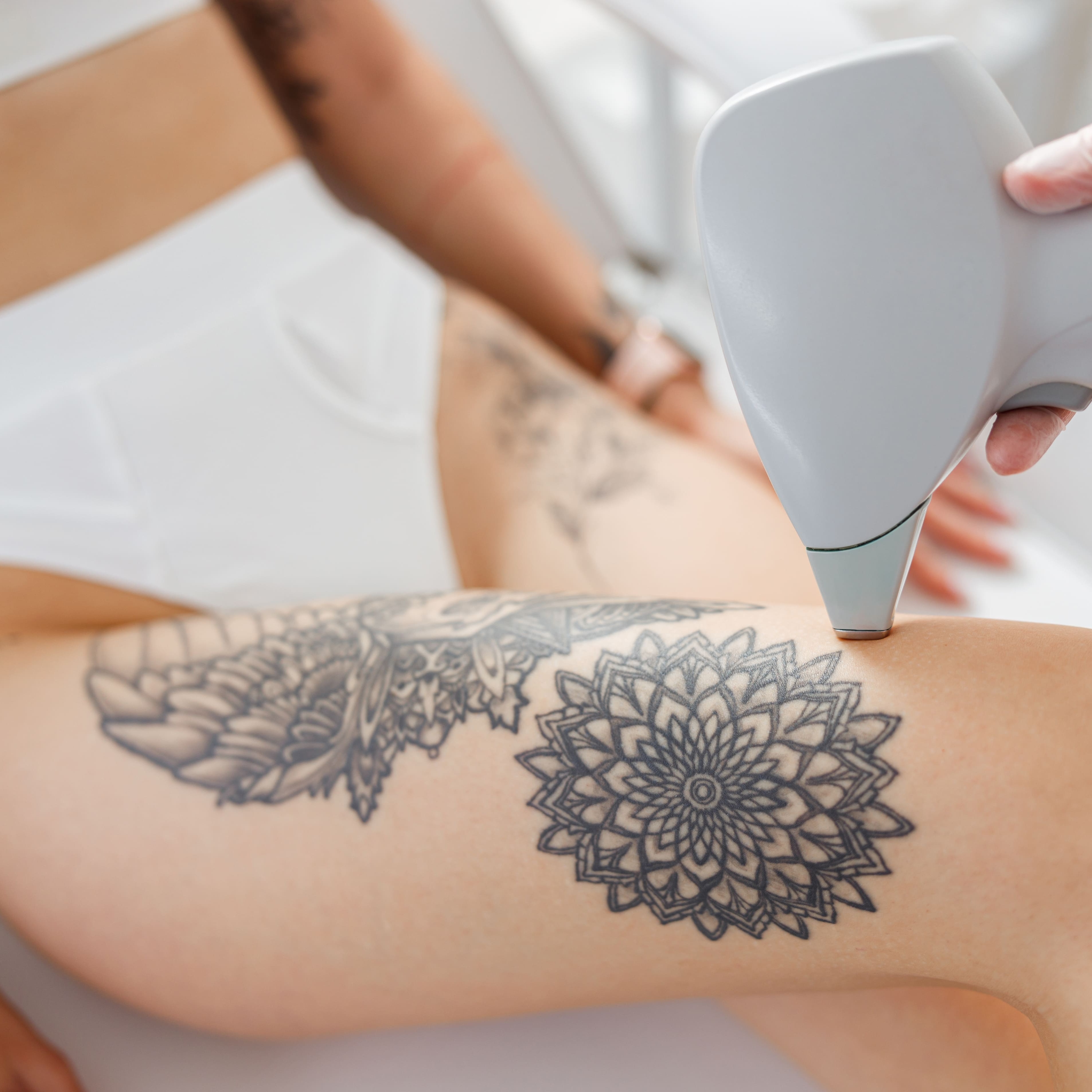 Laser Tattoo Removal 10x10" at Dreamland Health and Wellness in Indianapolis, IN
