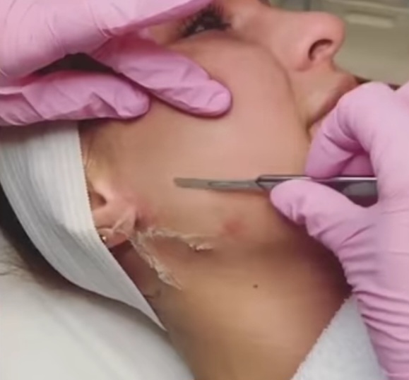 Dermaplaning Facial