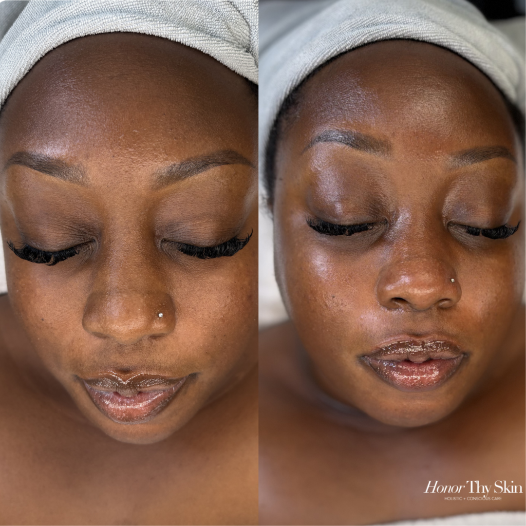 Radiance Facial at Honor Thy Skin in Charlotte, NC