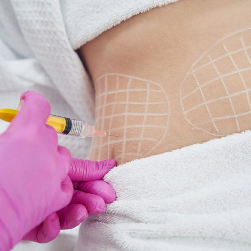 PCDC (Lipo Dissolve) at Injections Aesthetics By Lisa in San Antonio, TX