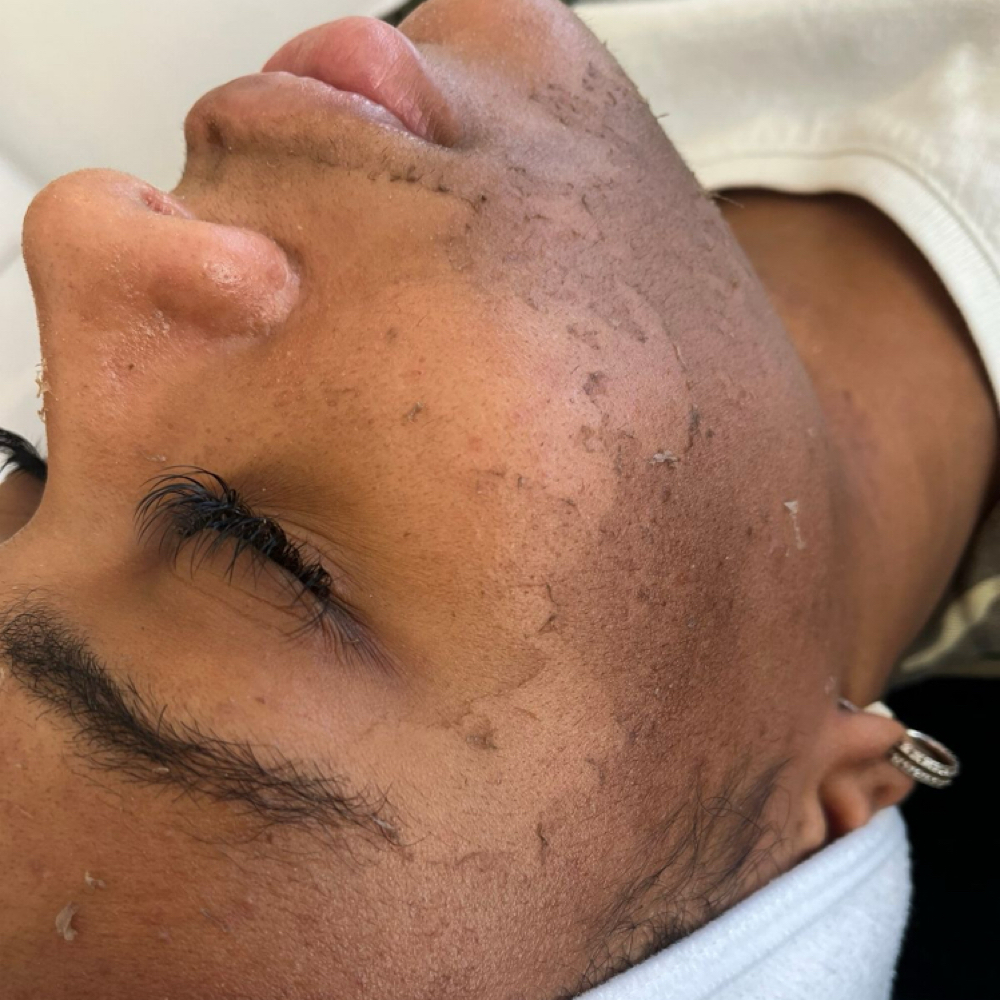 Acne  Peel at The Pink Room Studio in Huntsville, AL