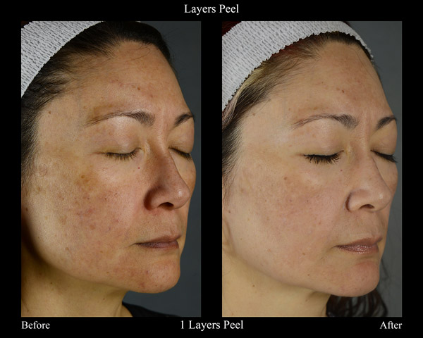 Chemical Peel
