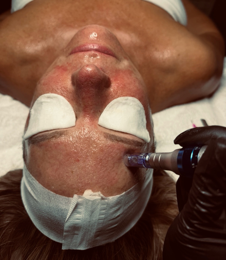 Microneedling Treatment