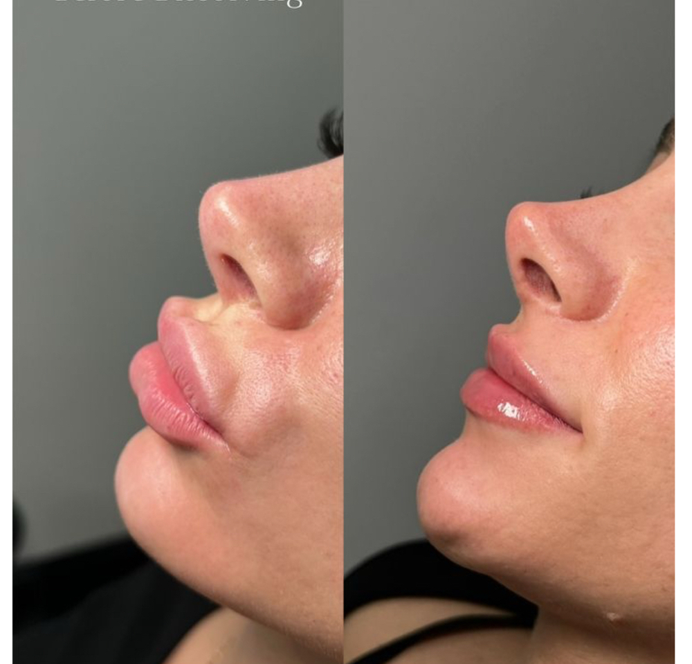 Lip Dissolving