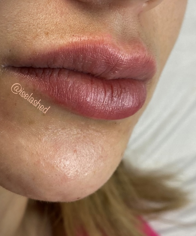 .5 ML Lip Filler