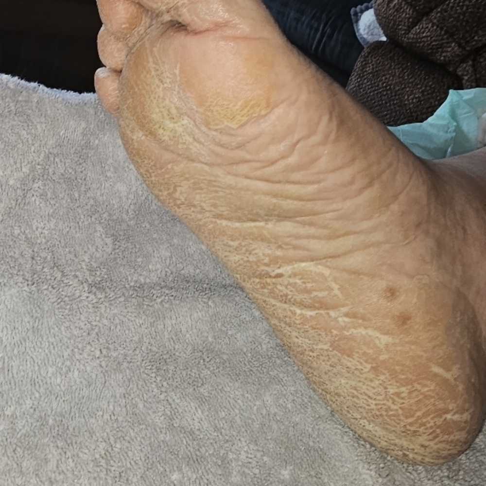 Therapeutic Waterless Pedicure