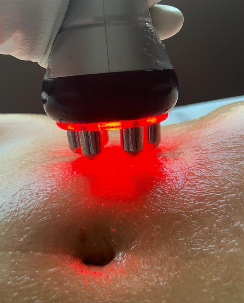 Body Contouring 1 Session