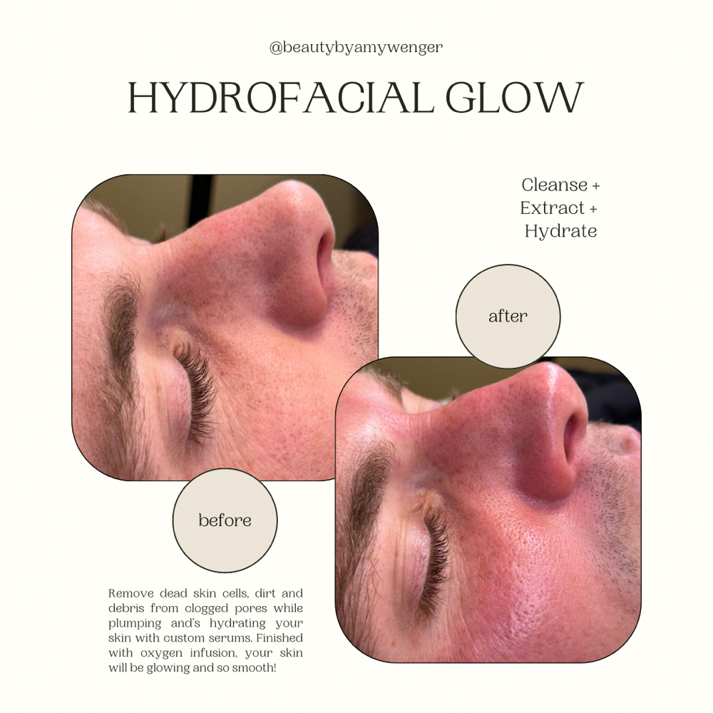 Hydrofacial