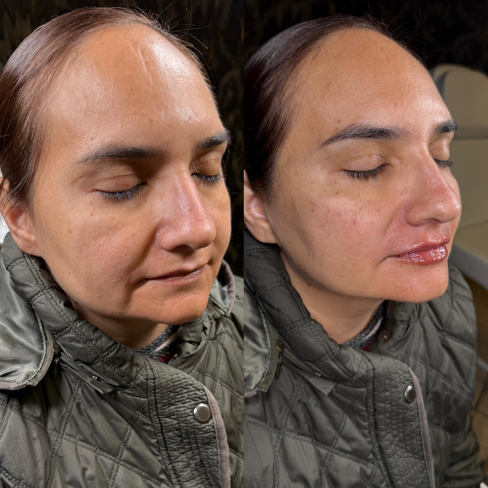 3 Syringes Facial Balancing