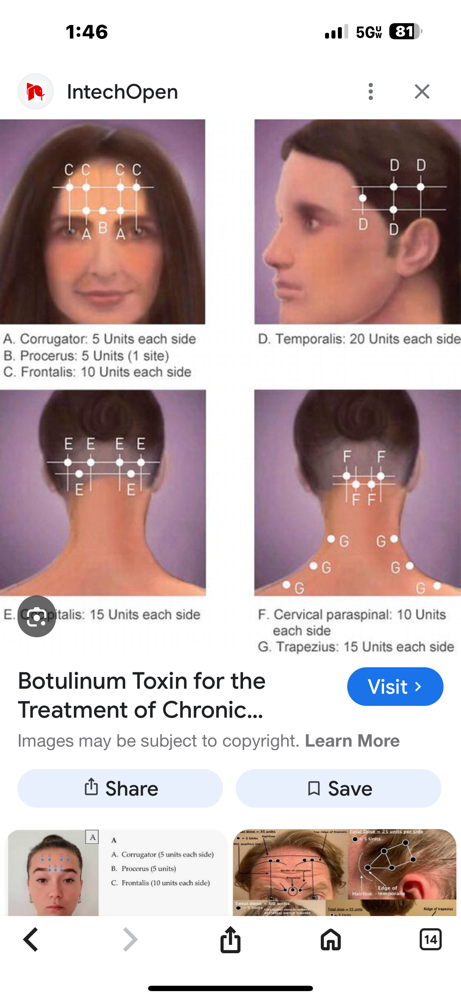 Botox For Migraines