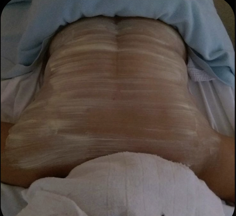 BACK-IAL TREATMENT