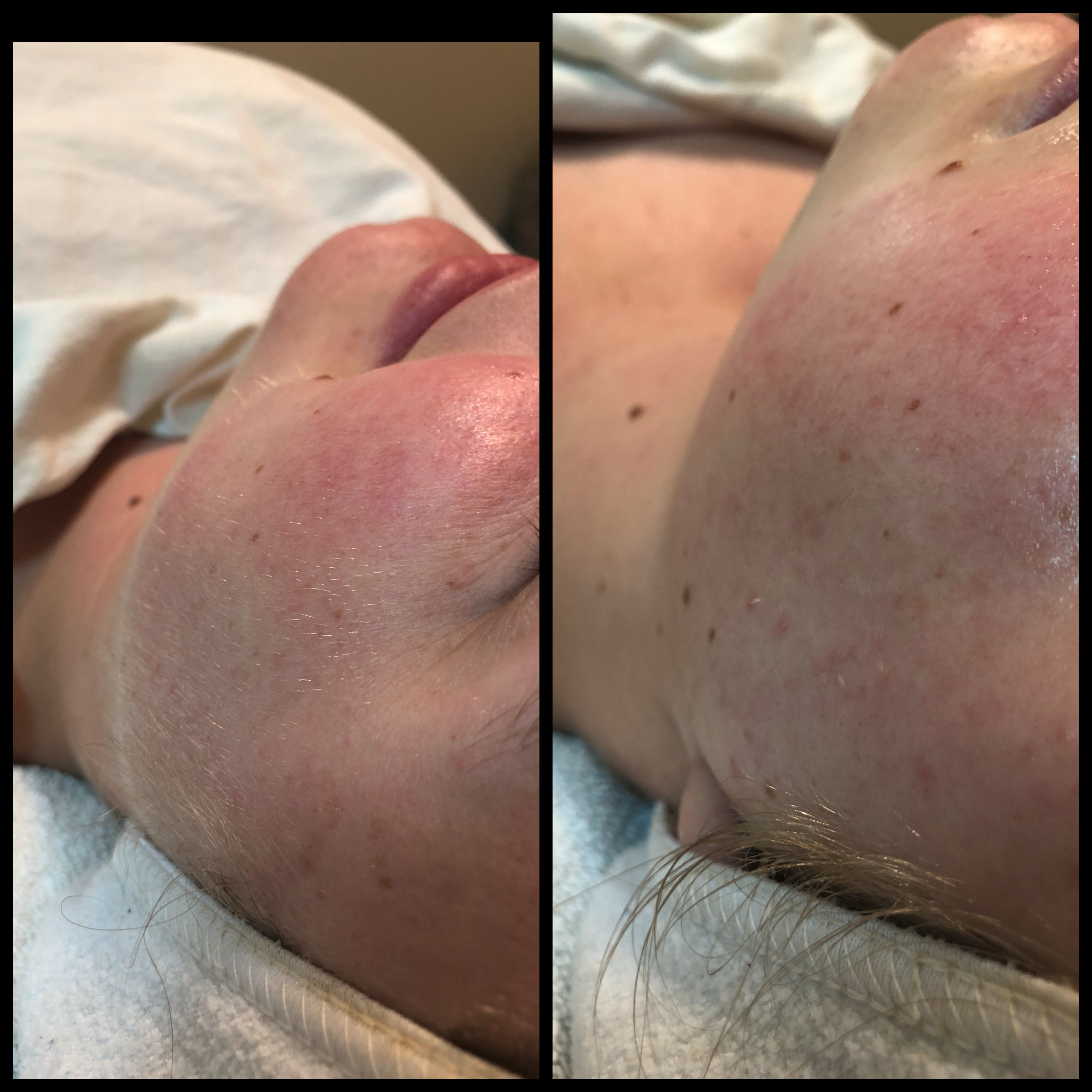 Dermaplane Facial