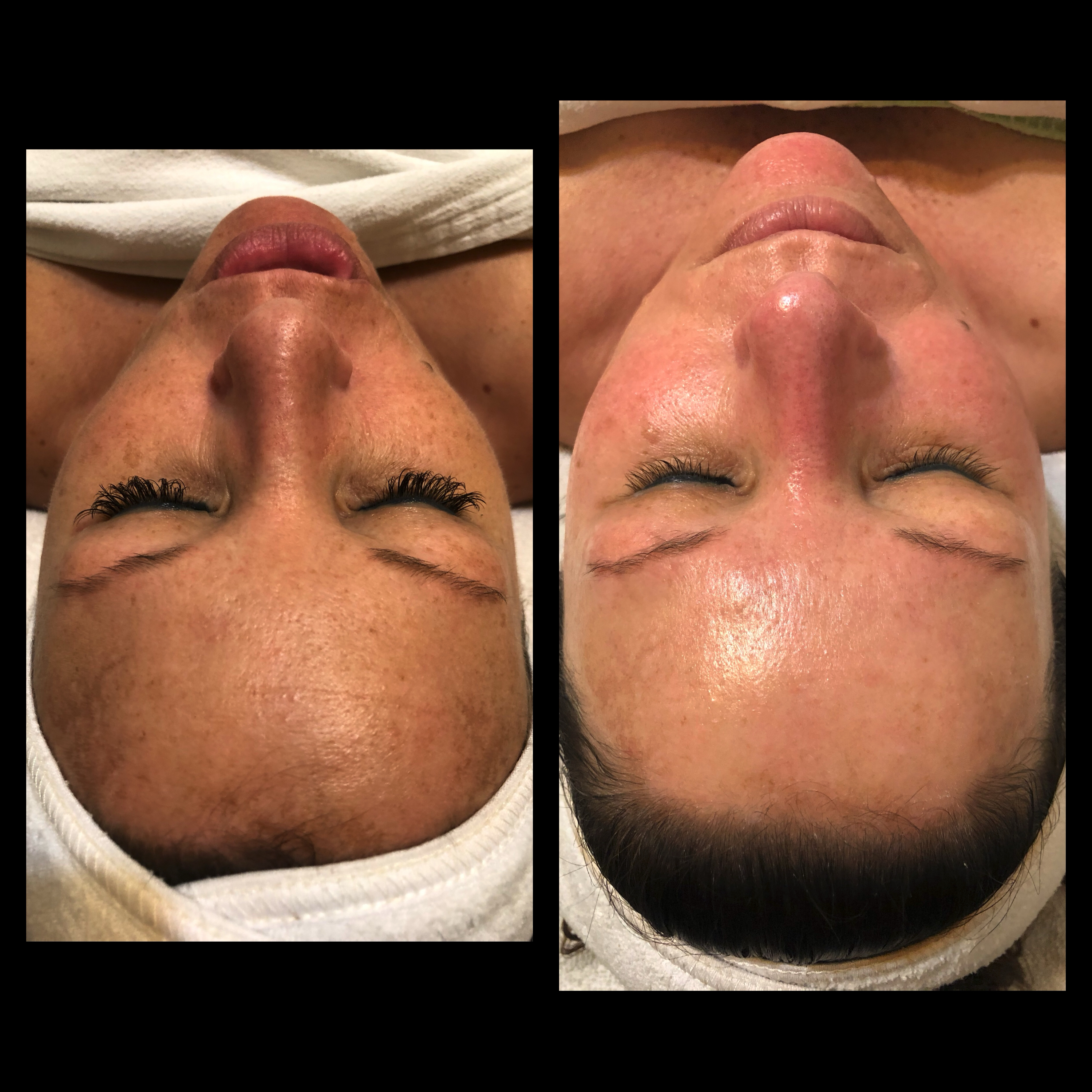 Enzyme Facial