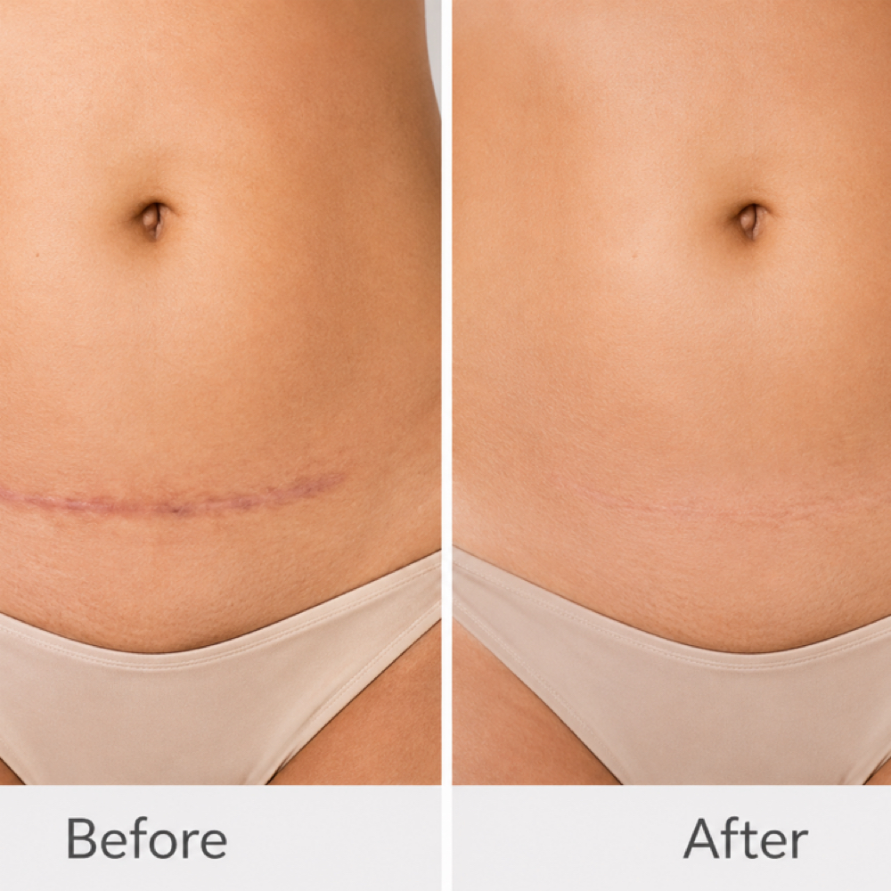 C-Section Scar Camouflage at Restored Hue Paramedical Studio in Atlanta, GA