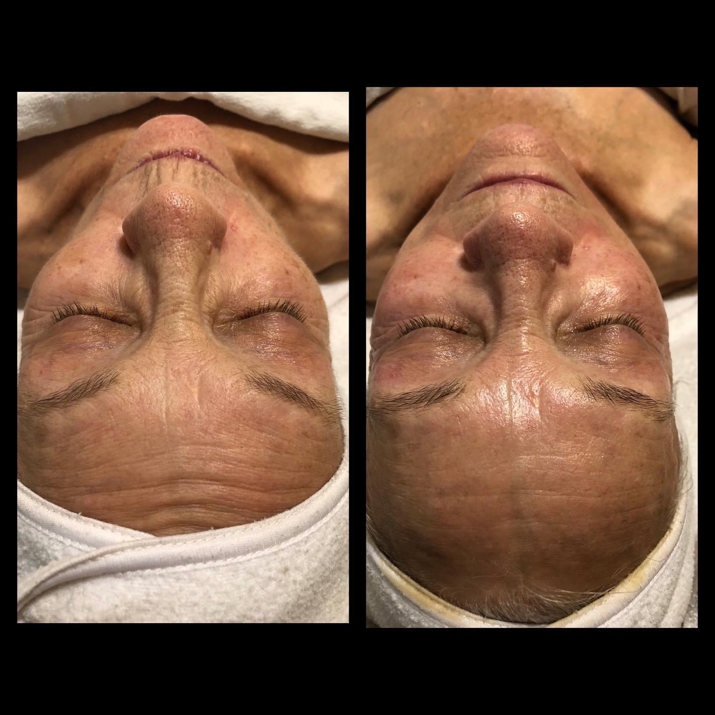 Nano-needling